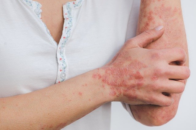 Femme souffrant de psoriasis : définition et symptômes de la maladie.