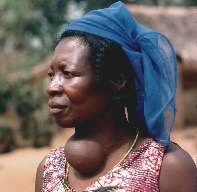 Femme présentant un goitre ; elle souffre de carence en iode.