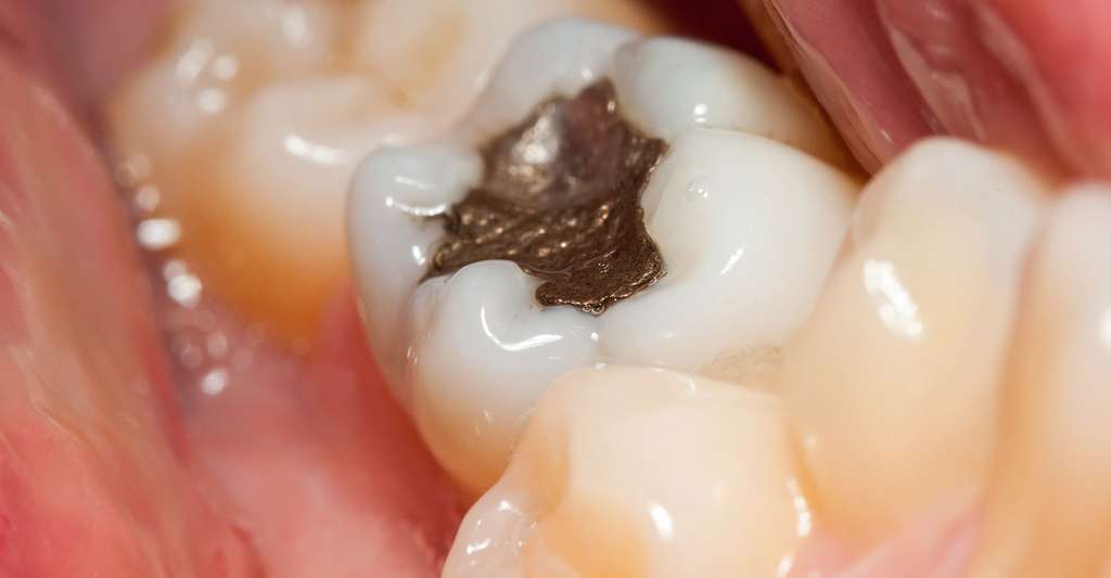 Dent avec un plombage dentaire, qui peut être l'origine d'une intoxication aux métaux lourds.